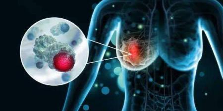 طريقة جديدة في علاج سرطان الثدي.. استهداف الخلايا السرطانية لتحفيز الجهاز المناعي