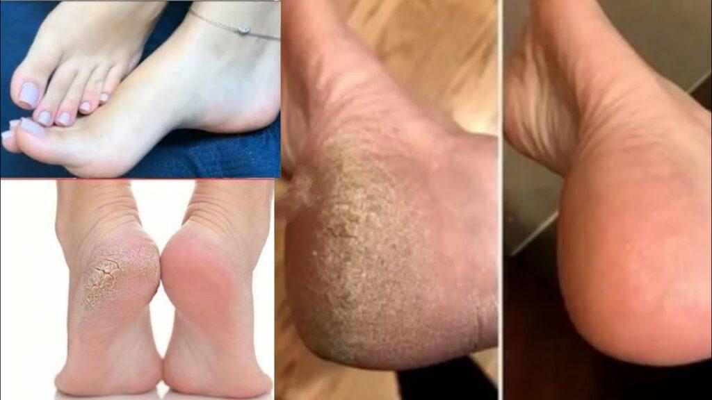 خلطة سحرية للتخلص من سواد القدمين