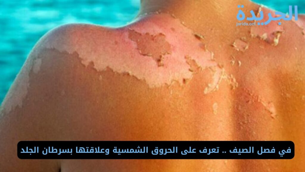 الحروق الشمسية وعلاقتها بسرطان الجلد