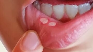 بوصفات طبيعية من المنزل.. القضاء على قرح الفم – الجريدة