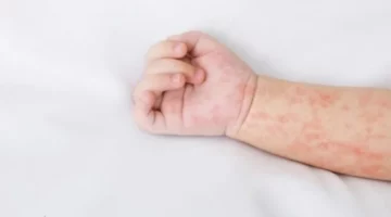 6 وفيات بـ “بوحمرون” خلال أسبوع – الجريدة