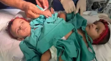 حصريًا رحلة فصل التوأم يارا ولارا وكيف تحققت المعجزة الطبية في الرياض